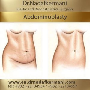 abdominoplasty