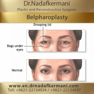 belpharoplasty