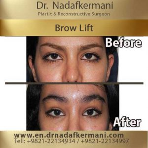 brow lift