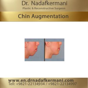 chin augmentation surgery