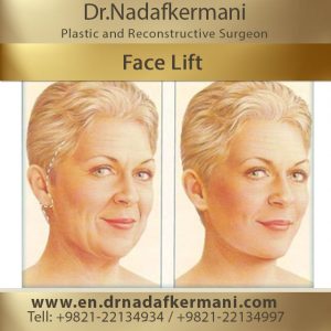 face-lift