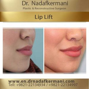 lip lift