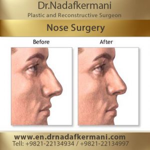 nose-surgery