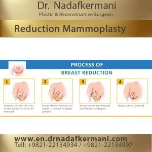 reduction mammoplasty