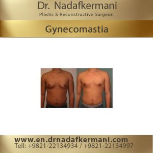 gynecomastia