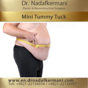 mini tummy tuck