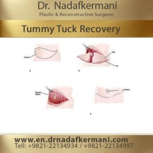 tummy tuck recovery