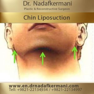 chin and neck liposuction