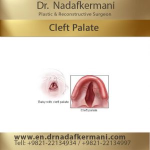 cleft palate