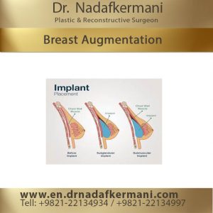 breast augmentation