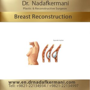 breast reconstruction surgery