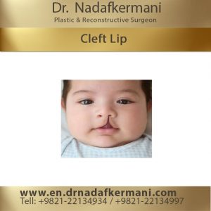 cleft lip