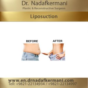 liposuction