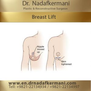 benefits of a breast lift