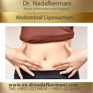 abdominal liposuction