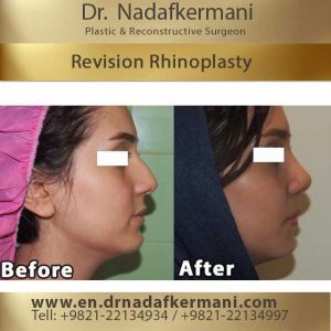 revision rhinoplasty