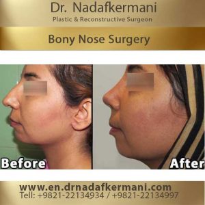 bony nose surgery