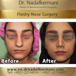 fleshy nose surgery